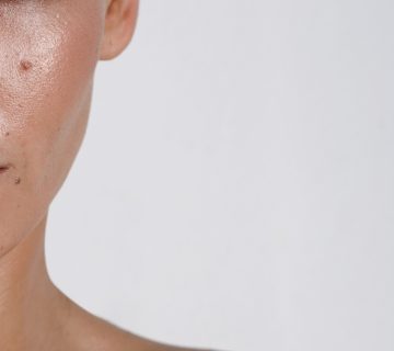 oily skin girl بشرة دهنية - حب الشباب