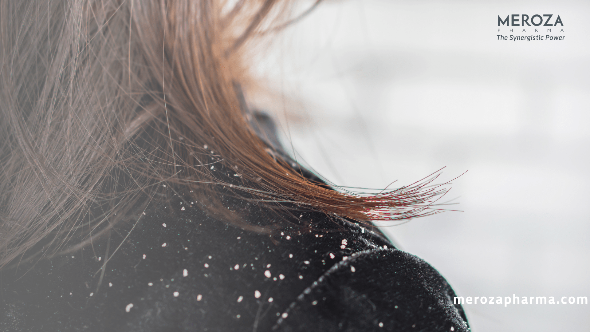 Mistakes That Make Dandruff Worse