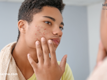 Teenager with acne-prone skin examining facial pimples in the mirror before using the best acne treatment gel for clearer-looking skin